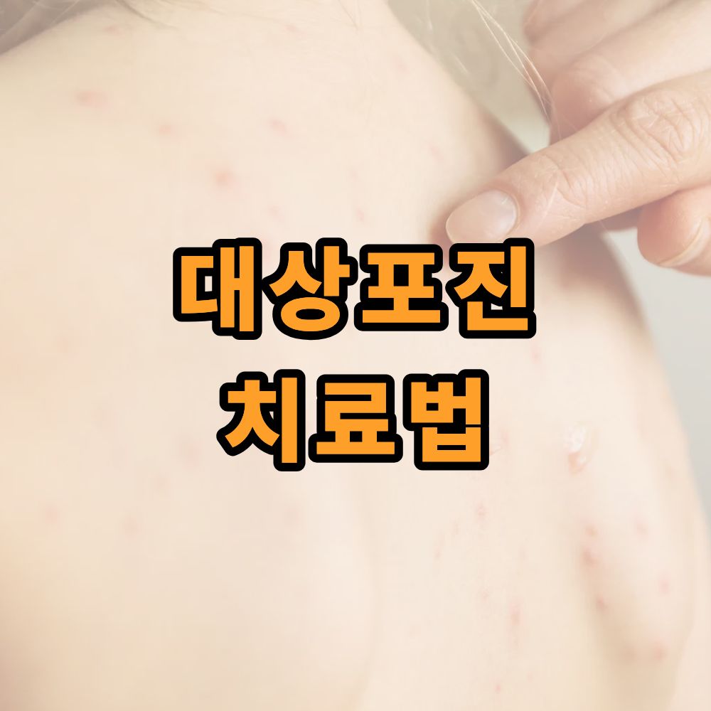 대상포진 치료법